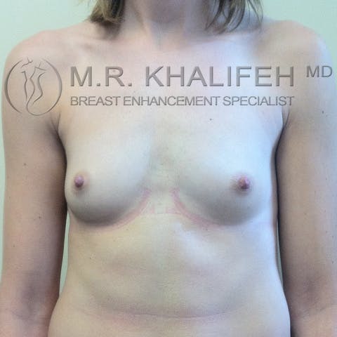 Fat Transfer Breast Augmentation Gallery - Patient 3761927 - Image 1