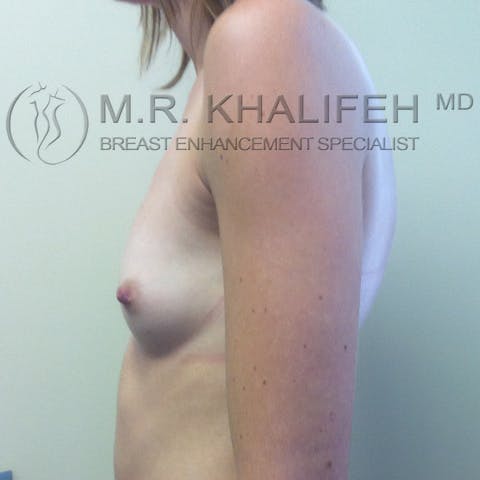 Fat Transfer Breast Augmentation Gallery - Patient 3761927 - Image 5