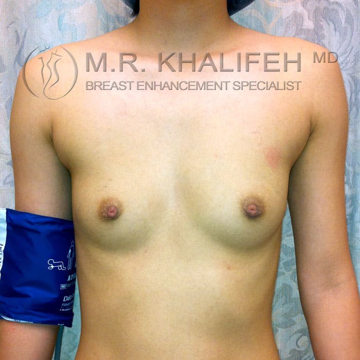 Breast Augmentation Gallery - Patient 3761933 - Image 1