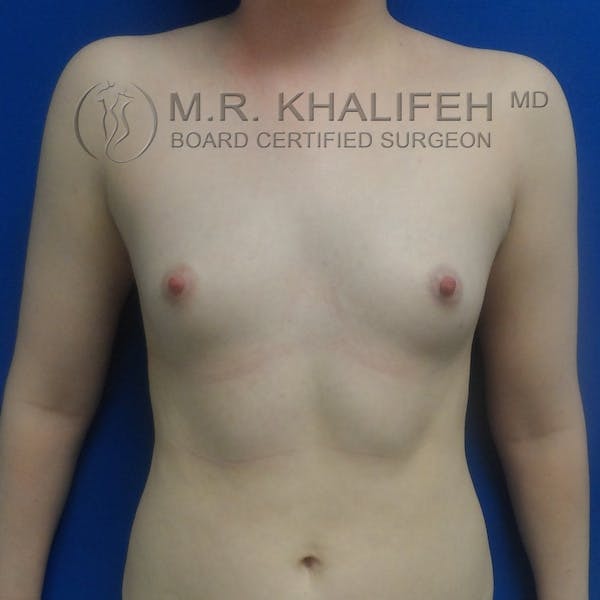 Fat Transfer Breast Augmentation Gallery - Patient 3761935 - Image 1