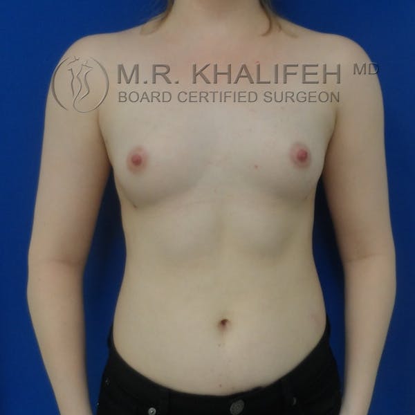 Fat Transfer Breast Augmentation Gallery - Patient 3761935 - Image 2