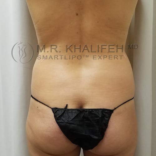 Flank-Lower Back Liposuction Gallery - Patient 92882096 - Image 1