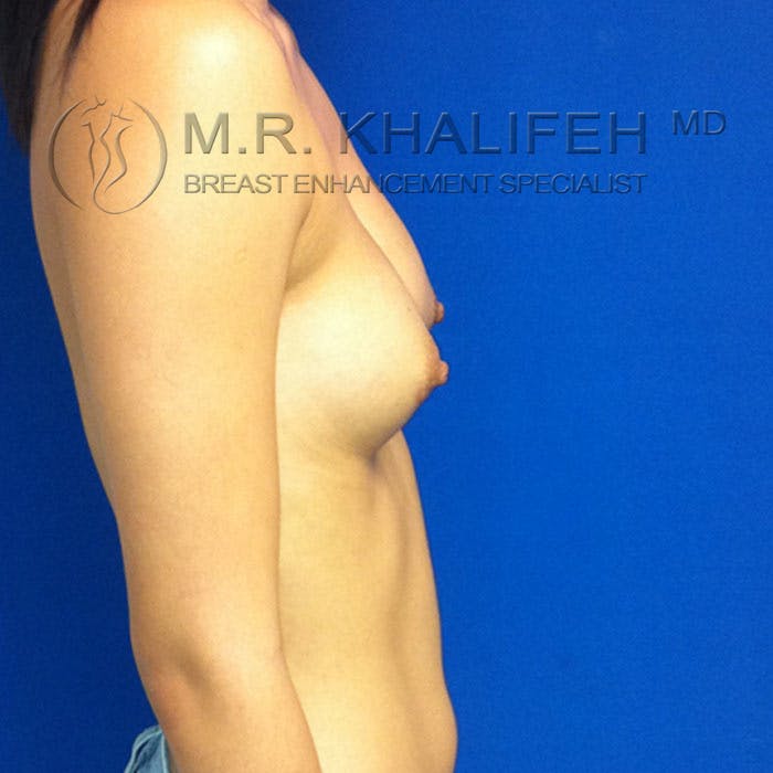 Breast Augmentation Gallery - Patient 3761933 - Image 6