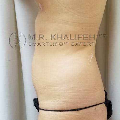 Flank-Lower Back Liposuction Gallery - Patient 92882096 - Image 3