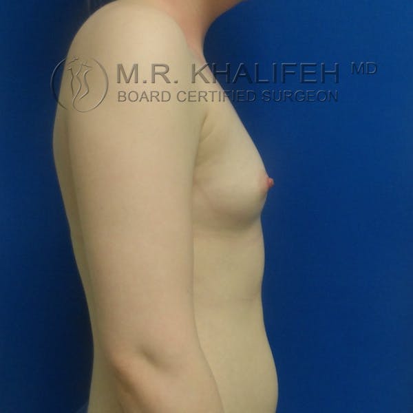 Fat Transfer Breast Augmentation Gallery - Patient 3761935 - Image 5