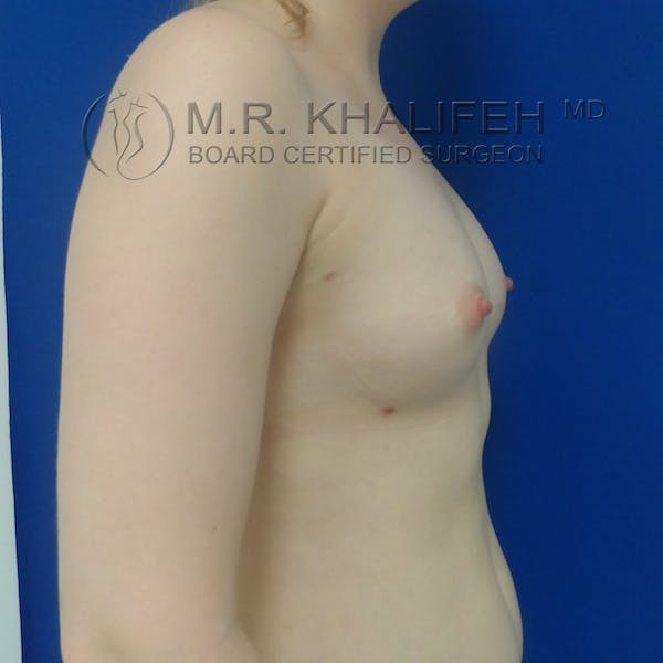 Fat Transfer Breast Augmentation Gallery - Patient 3761935 - Image 6