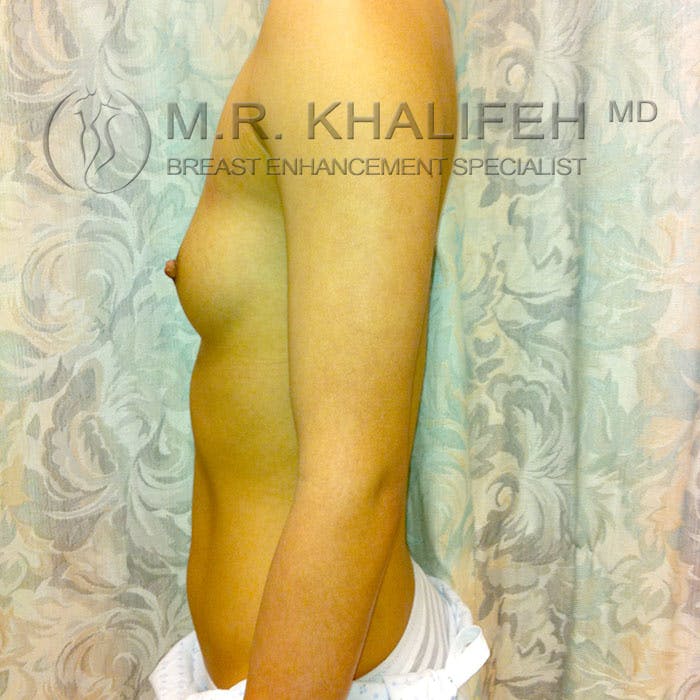 Breast Augmentation Gallery - Patient 3761933 - Image 9