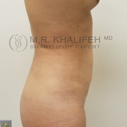 Flank-Lower Back Liposuction Gallery - Patient 92882096 - Image 6