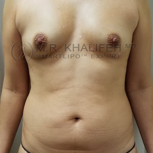 Flank-Lower Back Liposuction Gallery - Patient 92882096 - Image 7