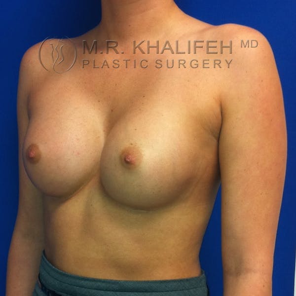 Breast Augmentation Gallery - Patient 3761938 - Image 4