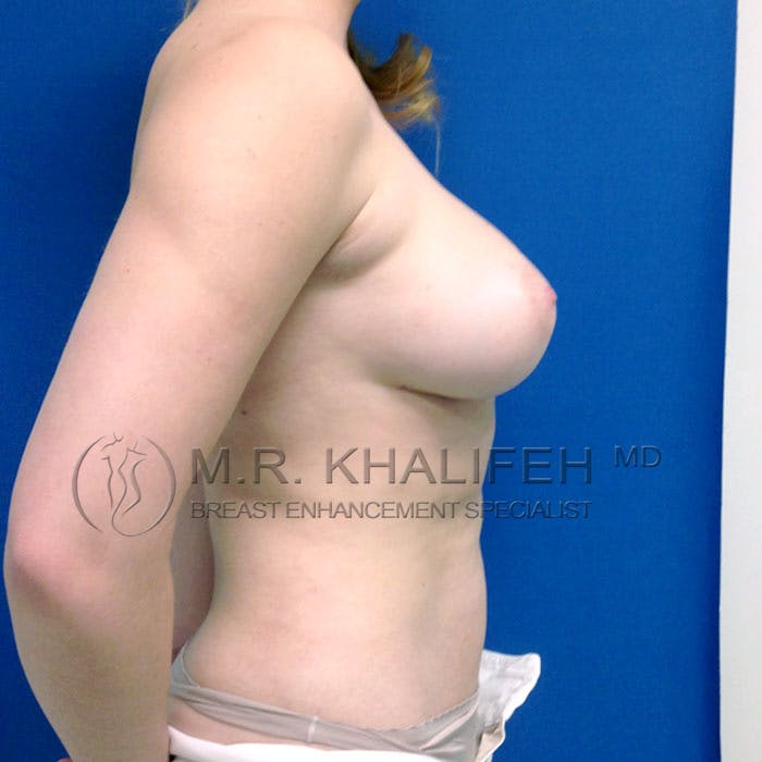 Fat Transfer Breast Augmentation Gallery - Patient 3761943 - Image 4