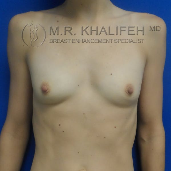 Breast Augmentation Gallery - Patient 3761948 - Image 1