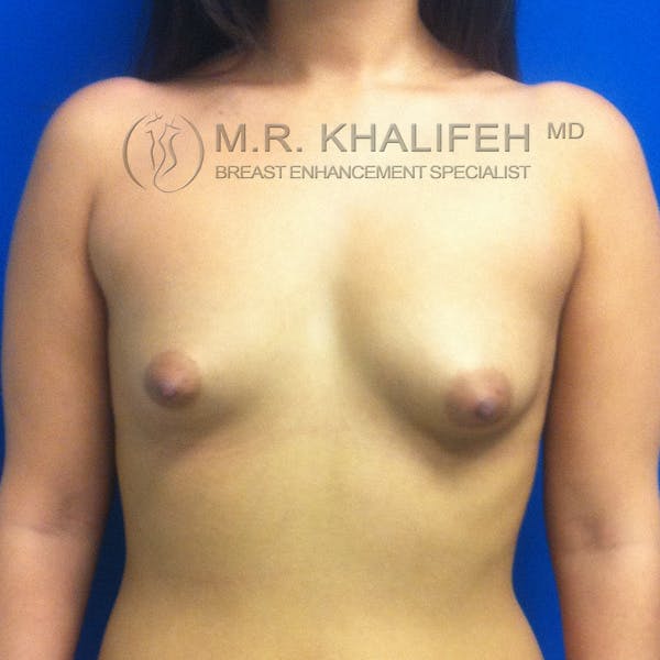 Breast Augmentation Gallery - Patient 3761954 - Image 1