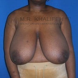 Breast Reduction Gallery - Patient 3761950 - Image 1
