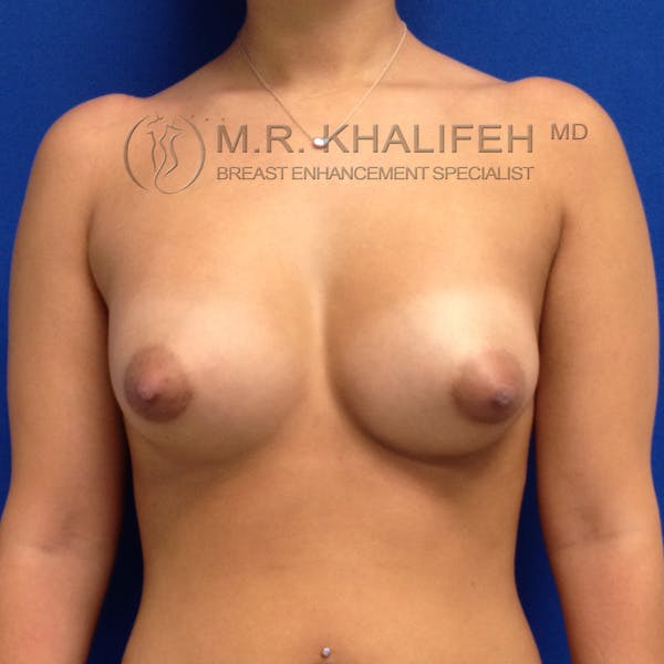 Breast Augmentation Gallery - Patient 3761954 - Image 2