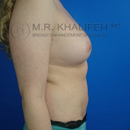 Fat Transfer Breast Augmentation Gallery - Patient 3761953 - Image 6