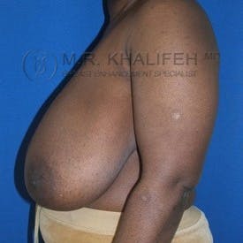 Breast Reduction Gallery - Patient 3761950 - Image 3