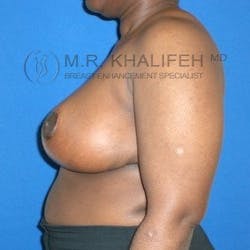 Breast Reduction Gallery - Patient 3761950 - Image 4