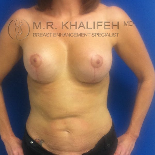 Breast Lift Gallery - Patient 3761955 - Image 2