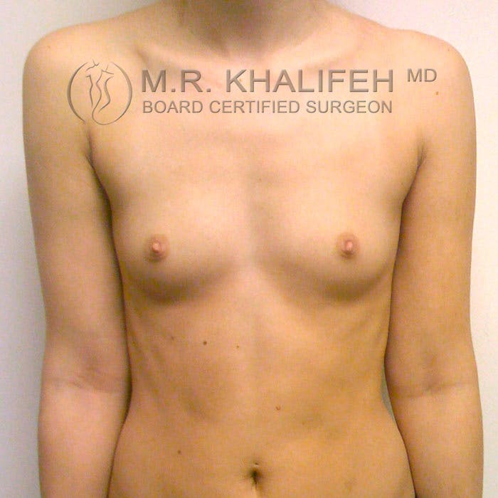 Breast Augmentation Gallery - Patient 3761958 - Image 1