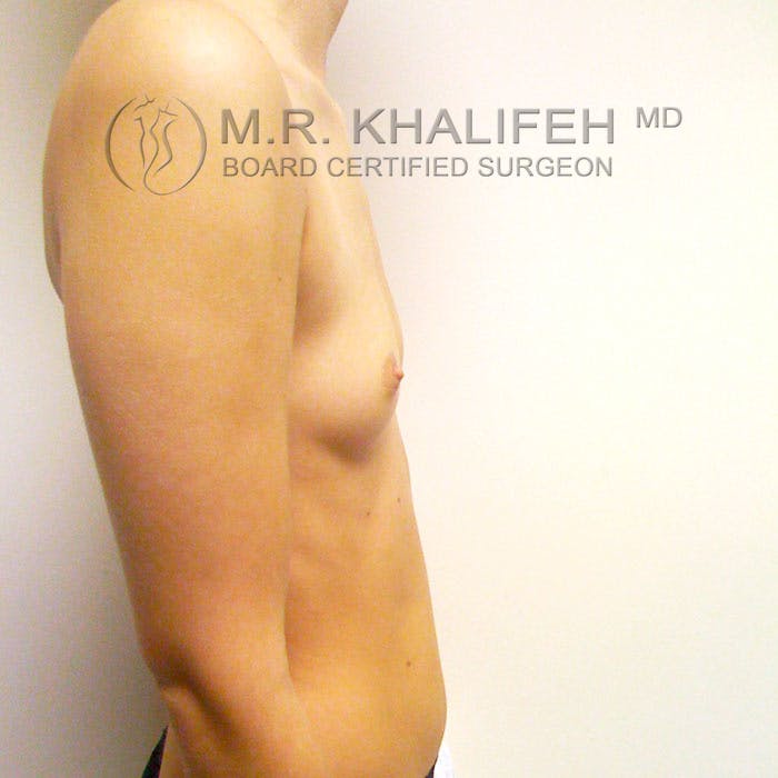 Breast Augmentation Gallery - Patient 3761958 - Image 3