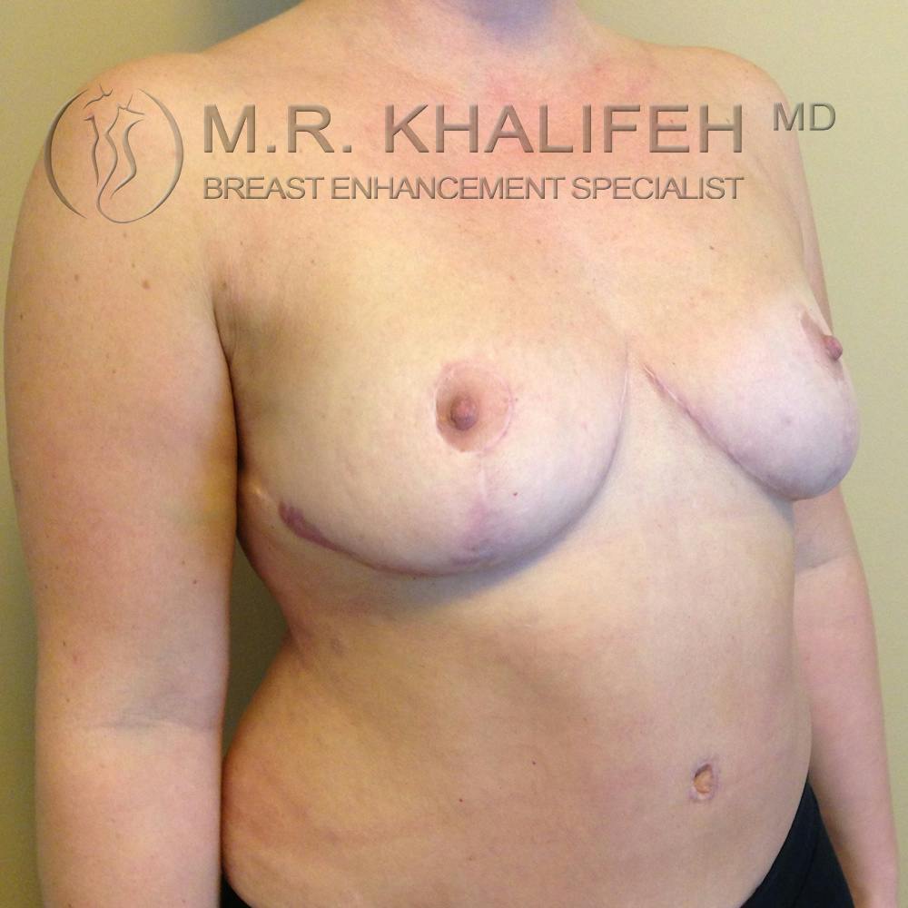Breast Reduction Gallery - Patient 3761957 - Image 6