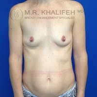 Breast Augmentation Gallery - Patient 3761961 - Image 1