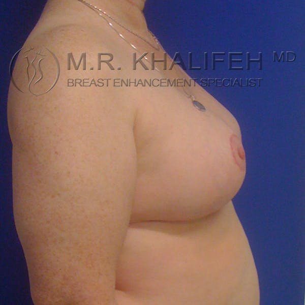 Breast Reduction Gallery - Patient 3761960 - Image 6