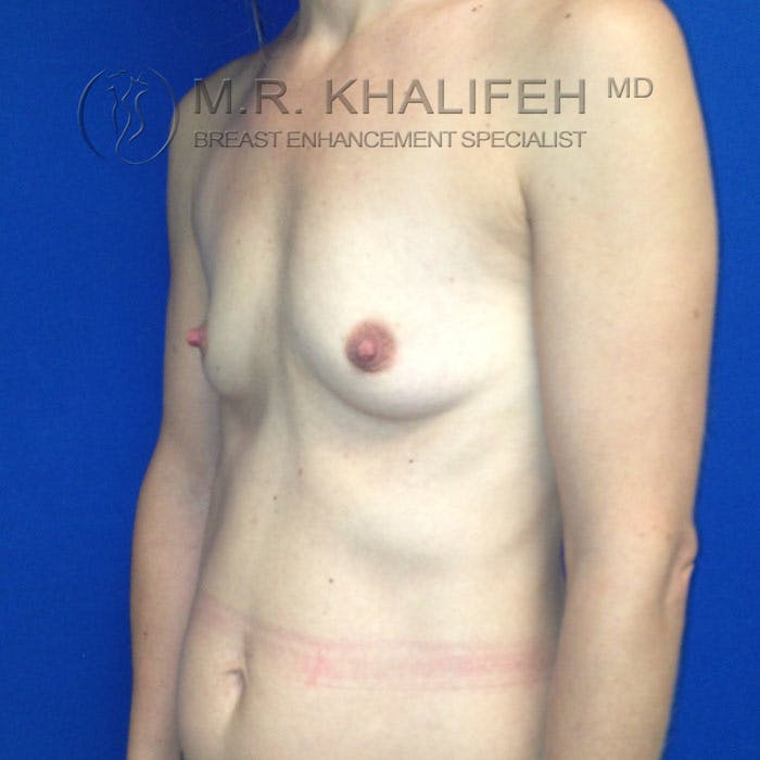 Breast Augmentation Gallery - Patient 3761961 - Image 5