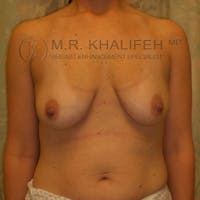 Breast Lift Gallery - Patient 3761967 - Image 1