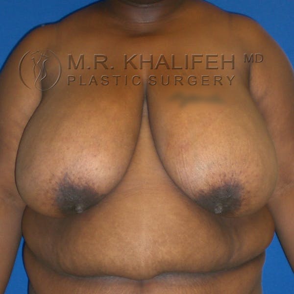 Breast Reduction Gallery - Patient 3761970 - Image 1