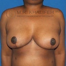 Breast Reduction Gallery - Patient 3761974 - Image 2