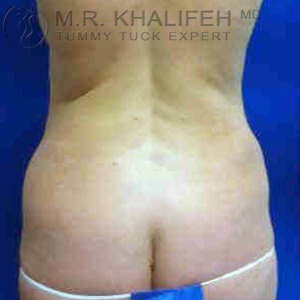 Tummy Tuck Gallery - Patient 3761996 - Image 5
