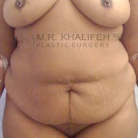 Tummy Tuck Gallery - Patient 3762008 - Image 1