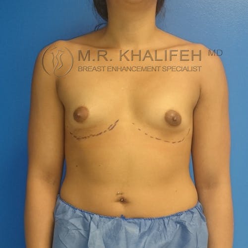 Breast Augmentation Gallery - Patient 3762010 - Image 1