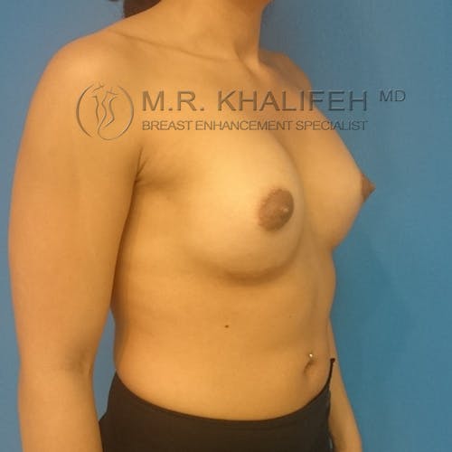 Breast Augmentation Gallery - Patient 3762010 - Image 4