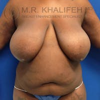 Breast Reduction Gallery - Patient 3762012 - Image 1