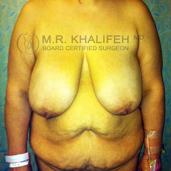 Breast Lift Gallery - Patient 3762011 - Image 1