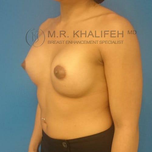 Breast Augmentation Gallery - Patient 3762010 - Image 8