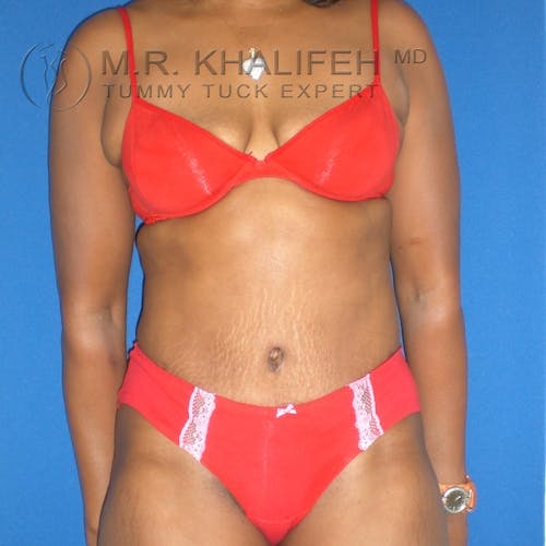 Tummy Tuck Gallery - Patient 3762017 - Image 2