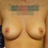Breast Augmentation Gallery - Patient 3762016 - Image 1