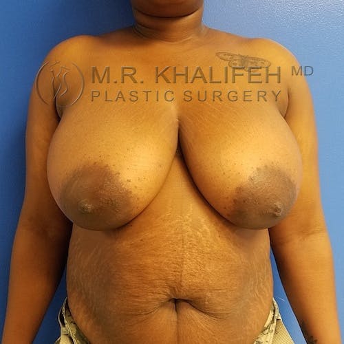 Breast Reduction Gallery - Patient 3762019 - Image 1