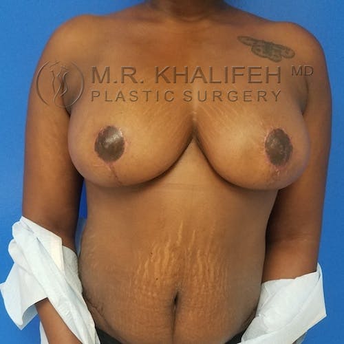 Breast Reduction Gallery - Patient 3762019 - Image 2