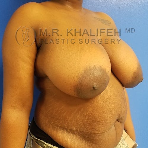 Breast Reduction Gallery - Patient 3762019 - Image 3