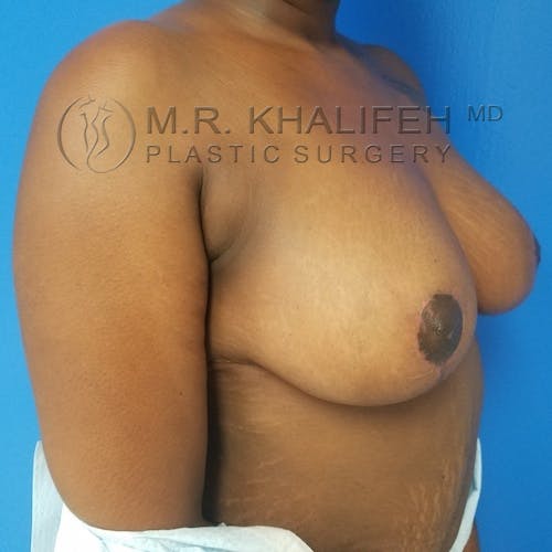 Breast Reduction Gallery - Patient 3762019 - Image 4