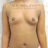 Breast Augmentation Gallery - Patient 3762021 - Image 1