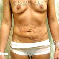 Tummy Tuck Gallery - Patient 3762022 - Image 1