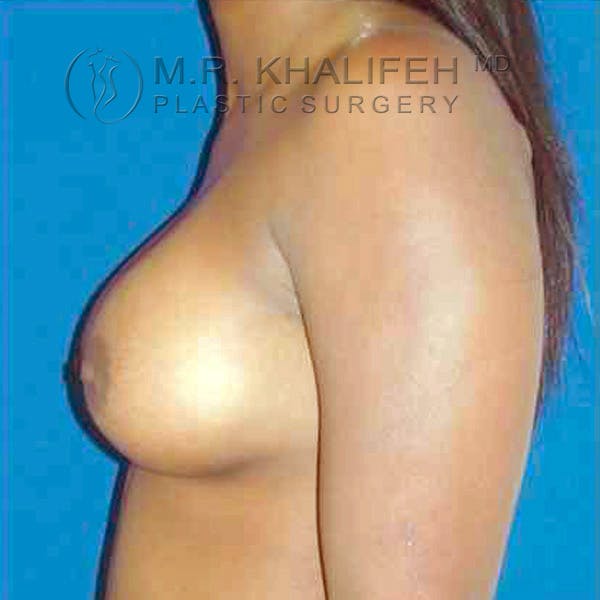 Breast Augmentation Gallery - Patient 3762021 - Image 4