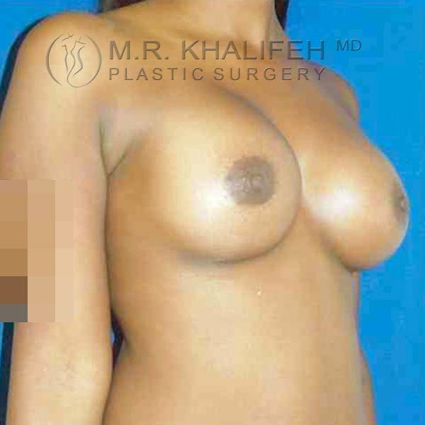 Breast Augmentation Gallery - Patient 3762021 - Image 6