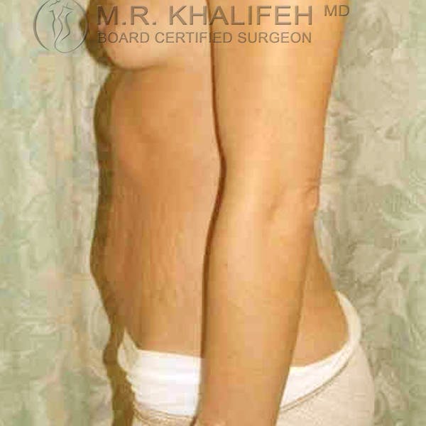 Tummy Tuck Gallery - Patient 3762022 - Image 5